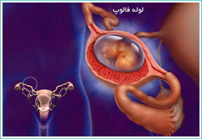بارداری خارج از رحم